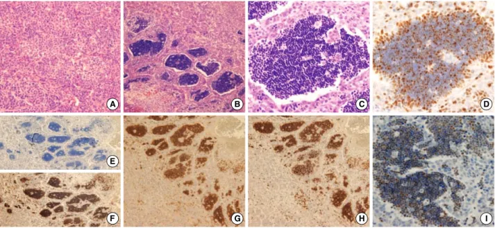 Fig. 1. Histological and immunohistochemical features. (A) The hepatocellular carcinoma is composed of poorly differentiated cells with trabecular pattern (H&amp;E, ×200)