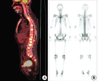 Fig. 1. Scanning findings for bones. (A) Disseminated hyperme- hyperme-tabolic lesion (maxSUV=9.0, L2 body) at the whole spine by PET.