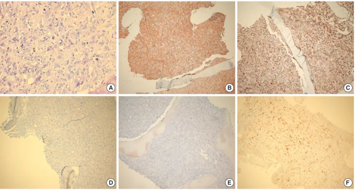 Fig. 3. Histopathological findings of bone marrow biopsy. (A) Non-cohesive proliferation of large pleomorphic neoplastic cells with large round-to-oval nuclei with vesicular chromatin and abundant foamy cytoplasm (H&amp;E stain, ×400)