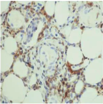 Fig. 3. Polymerase chain reaction of EB virus in blood mononu-