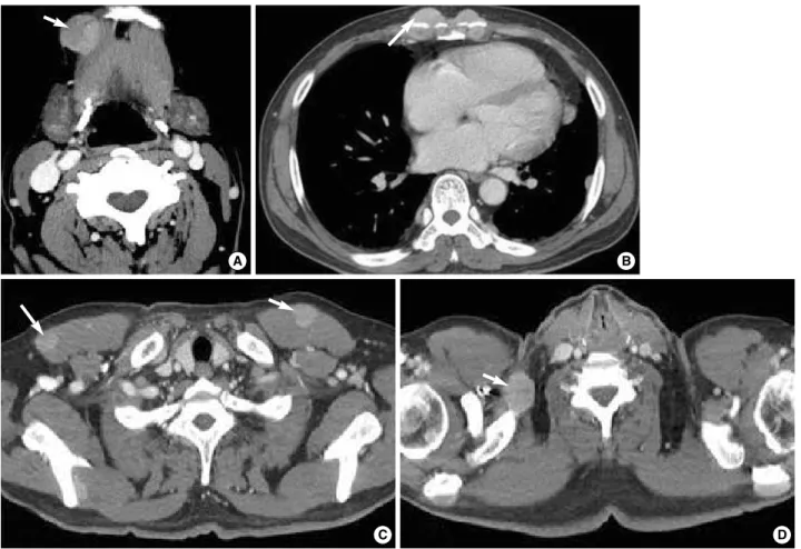 Fig. 3. CT imaging showing multiple areas of lymphoma infiltration. Arrows indicate lymphoma lesions