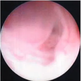 Fig. 3. Histologic preparation of a fibroepithelial polyp. The stroma of fibroepithelial polyp is covered by a layer of normal transitional epithelial cells (H&amp;E stain, ×200).