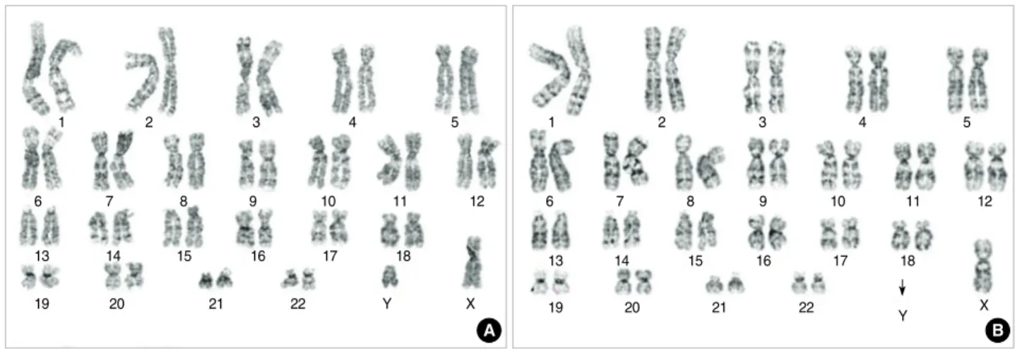 Fig. 2. GTG-banded karyotypes of the benign and malignant fibroblast cells from a NF1 patient
