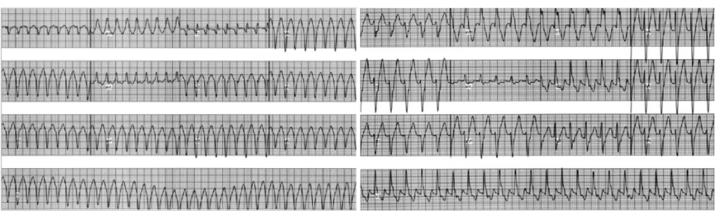 Fig. 2. An example of local electrocardiogram from an ablation catheter shows both the P-potential (   ) and sinus rhythm changes to wide QRS tachycardia with radiofrequency energy delivery.
