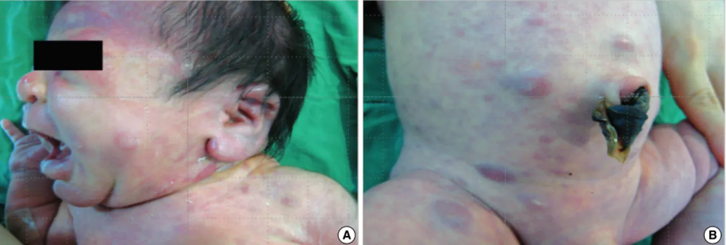 Fig. 1. Gross view of the skin. (A, B) There are widespread, scattered, yellowish-colored firm nodules with multiple purpuric macules and papules predominantly on the face and the trunk