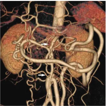 Fig. 4. Computed tomographic angiography showed a patent graft between thoracoabdominal junction to aortic bifurcation (arrows).