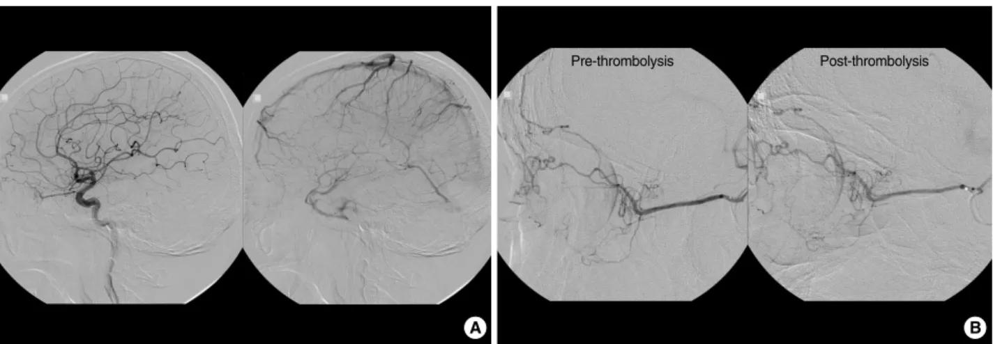 Fig. 2. Arterial phase and venous phase of left internal carotid angiogram (A) in case 1