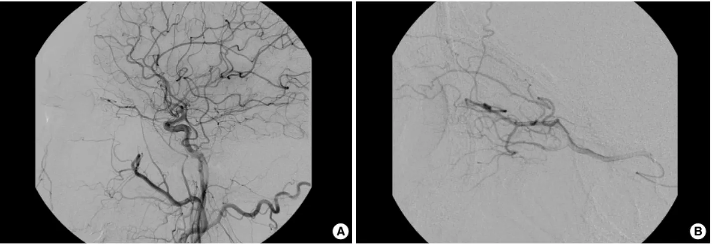 Fig. 5. Common carotid angiogram in case 2 (A). There was no definite occlusion and remarkable lesion in ophthalmic artery and main trunk of intracerebral arteries