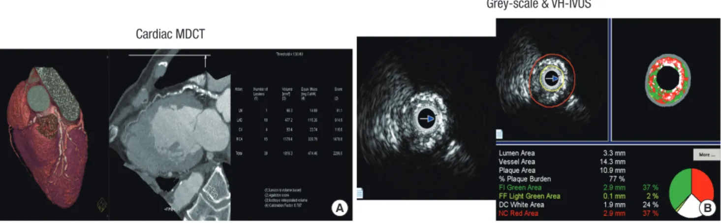 Fig. 1. The examples of coronary artery calcium detected by cardiac multidetector computed tomography (MDCT) (A) and plaque components assessed by virtual histology-in- histology-in-travascular ultrasound (VH-IVUS) (B).