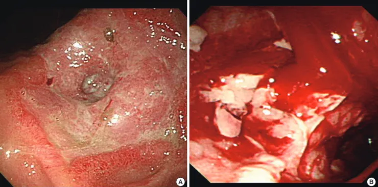 Fig. 1. Endoscopic findings. (A) Severe pyloric stricture was observed, followed by a caustic lye injury 4 weeks later