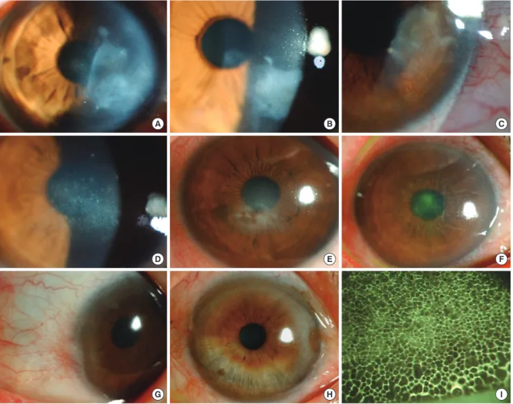 Fig. 2. Clinical features of patients with ocular demodecosis (A, case 4; B, case 5; C, case 9; D, case 1; E, case 3; F, case 7; G, case 2; H, case 6; I, case 8)