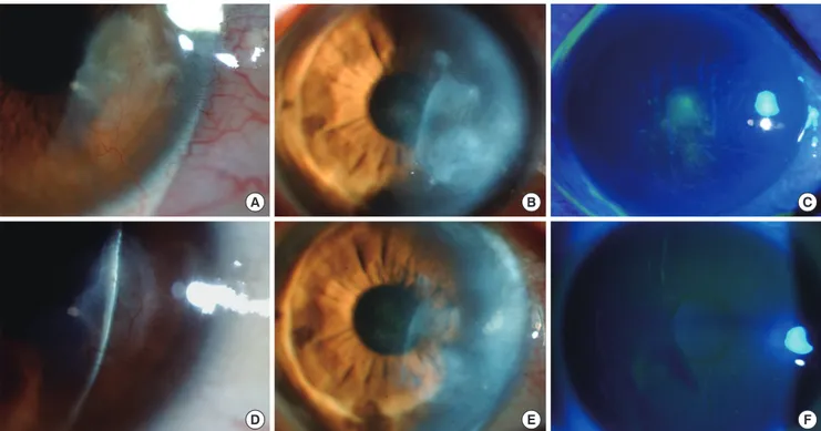 Fig. 3. Clinical appearance before and after lid scrubbing treatment with tea tree oil in patients with ocular demodecosis