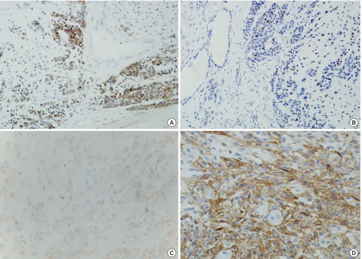 Fig. 3. In CXPA-NLD, focally positive staining for Bcl-2 (A) and p53 (B) was observed in the malignant components