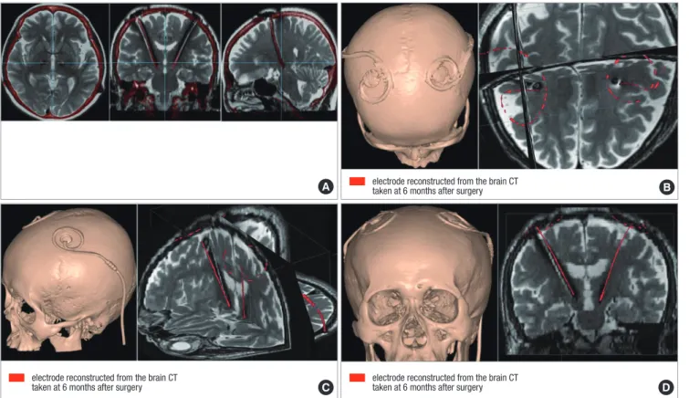 Fig. 5. Fused images of brain CT and MRI taken after surgery. Fused images of the brain CT and the brain MRI both taken at 6 months after bilateral subthalamic stimulation  are illustrated