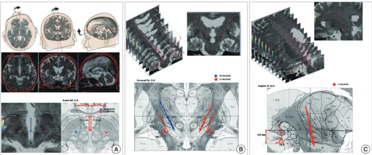 Fig. 1. Fused images of the preoperative MRI and postoperative CT. The T2-weighted axial images of brain MRI taken before surgery are fused with 3-D spiral CT scan images  at the data set of 1-mm thickness reformatted images, aligned to anterior commissure