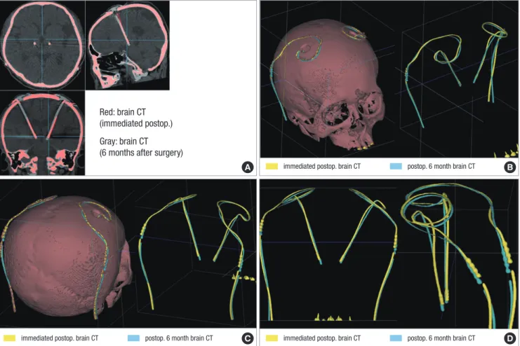 Fig. 4. Fused images of two brain CT scans taken after surgery. The fused images obtained from the CT scans taken at the immediate postoperative day and six months after  surgery are aligned along the AC-PC line at the level of AC and PC in axial, sagittal