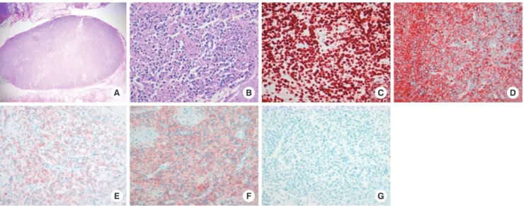 Fig. 5. Pathological finding of surgically excised cervical lymph node. (A) The lymph node is well capsulated with marked degree of necrosis (H&amp;E, × 100), (B) Neoplastic infil- infil-trate of relatively pleomorphic lymphoid cells with scanty cytoplasm,