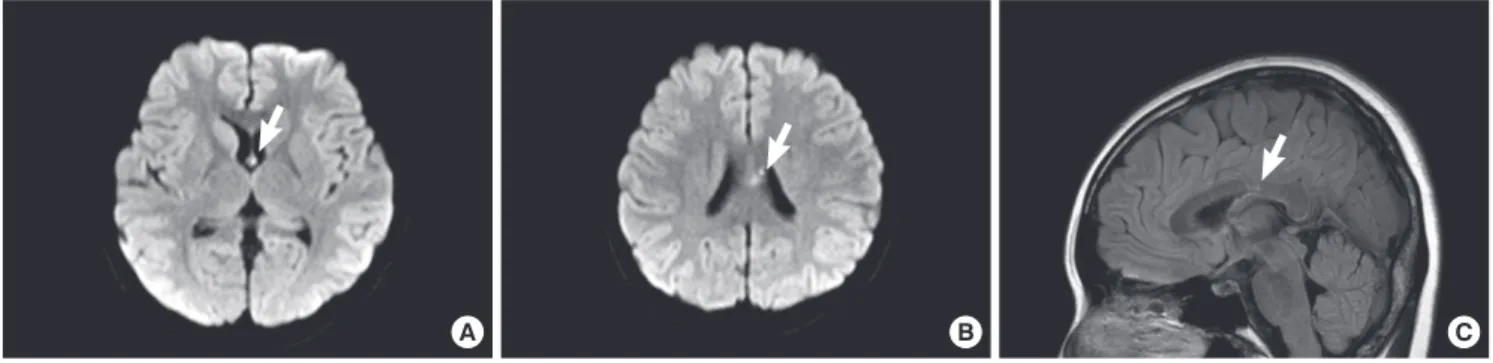 Fig. 4. Magnetic resonance image of the brain. (A, B) Diffusion weighted images, showing a diffusion restricted lesion in the corpus callosum and left fornix