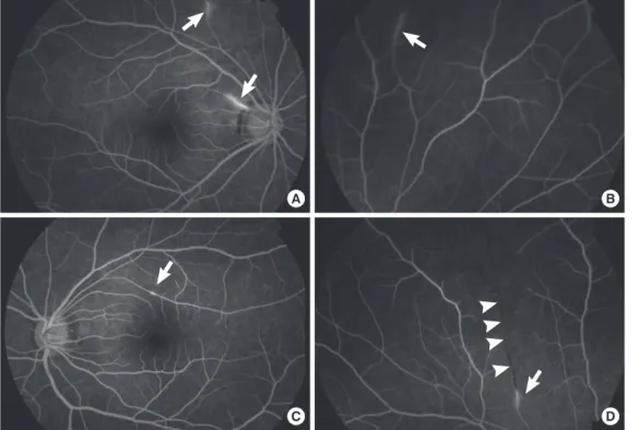 Fig. 5. Fluorescein angiography  showing hyperfluorescent  vasculi-tis lesions (arrows) (A-D) and an  obstructed branch retinal artery  (arrowheads) (D).