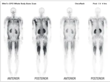 Fig. 1. A  99m Tc-diphosphonate scintigram bone scan showed increased uptake over  all extremities and muscles of the thorax and abdomen.