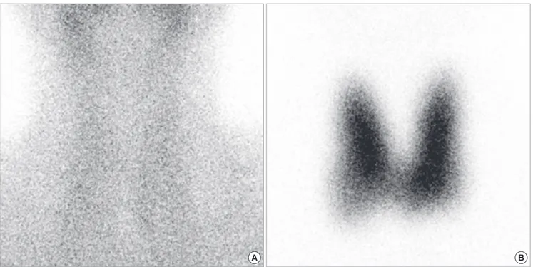 Fig. 1. Tc-99m scintigraphy showing non-visualization of the thyroid gland (A) and increased uptake throughout (B).