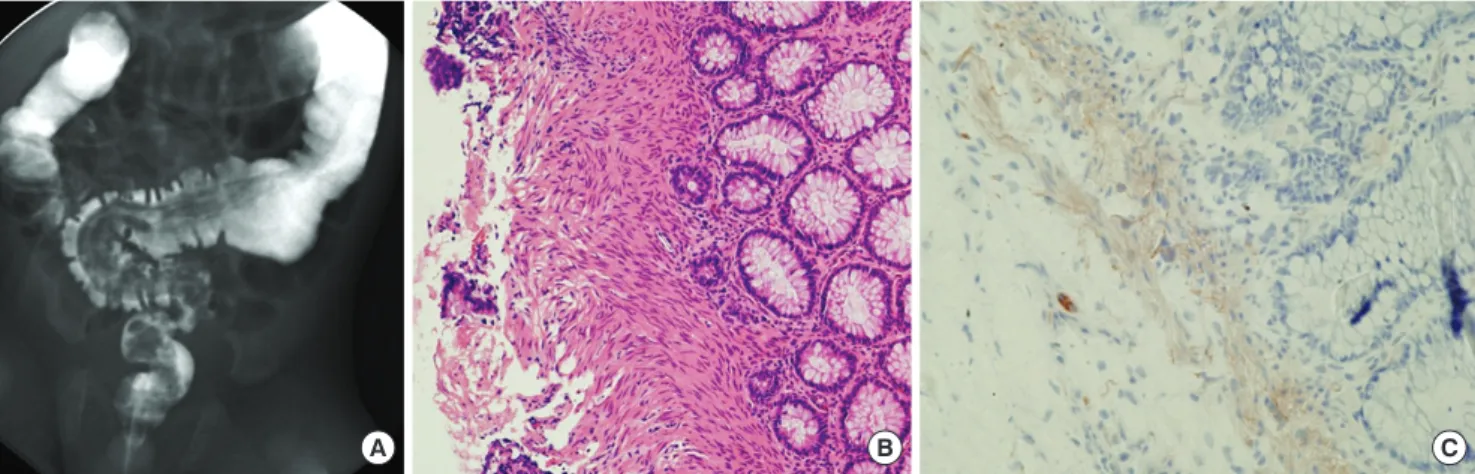 Fig. 1. Diagnosis of Hirschsprung’s disease. (A) Barium enema showing transitional zone (arrow) in the middle of the sigmoid colon