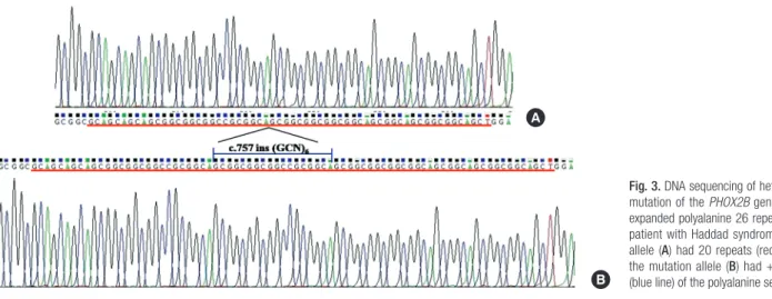 Fig. 3. DNA sequencing of heterozygous  mutation of the PHOX2B gene showing  expanded polyalanine 26 repeats