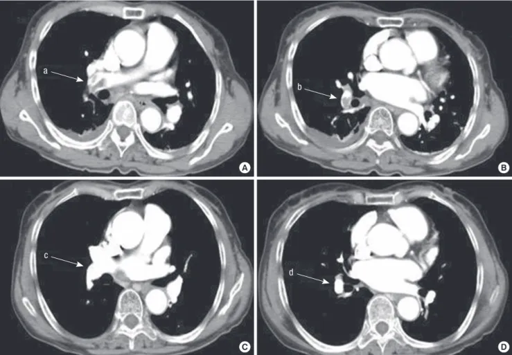 Fig. 5. Pulmonary artery computerized tomography angiogram from a PQ­intoxicated patient who suffered pulmonary artery thrombosis