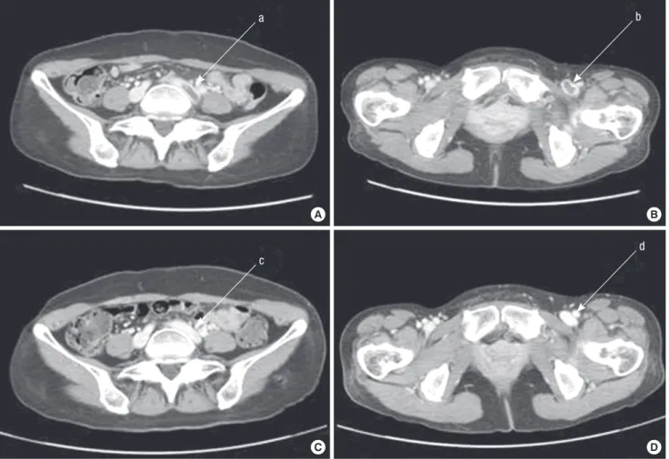 Fig. 6. Low extremity venogram computerized tomography from a PQ­intoxicated patient who suffered deep vein thrombosis in the leg