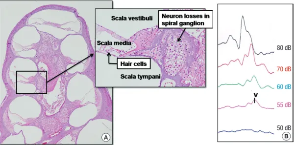 Fig. 2. Ouabain-induced spiral ganglion neuropathy. (A) There is a severe loss of spiral ganglion neurons (SGNs) without a loss of hair cells after 7 days of ouabain application (H 
