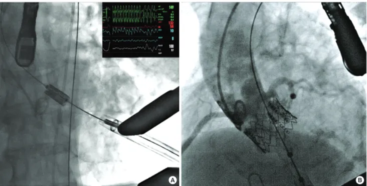 Fig. 1. Aortogram showing transcatheter transapical aortic valve implant. (A) Rapid pacing of 200 beats/min was performed to reduce the transaortic flow during the deployment  of prosthetic aortic valve