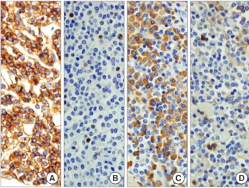 Fig. 3. The immunohistochemical findings. The lymphoid infiltrate was positive for  CD20, (A) Ki-67 labeling index was low (less than 5%), (B) kappa light chain-producing  plasma cells were detected, (C) with the exclusion of lambda light chain-producing  