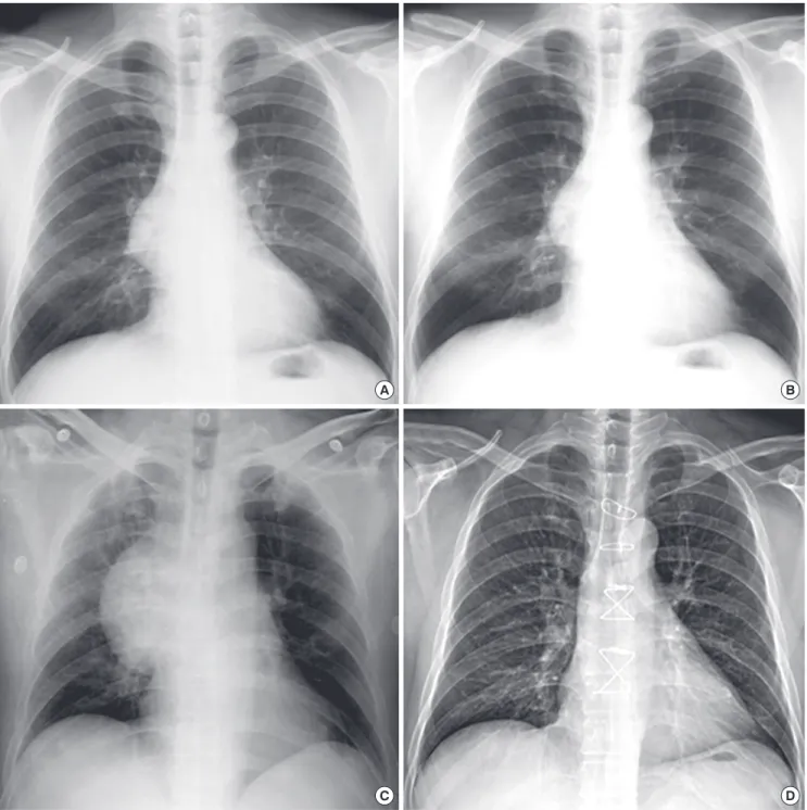 Fig. 1. Serial radiographic changes of the superior vena cava (SVC) aneurysm. Chest radiography at 2 yr ago (A) and 1 month (B) ago revealed the SVC aneurysm without any  changes in size