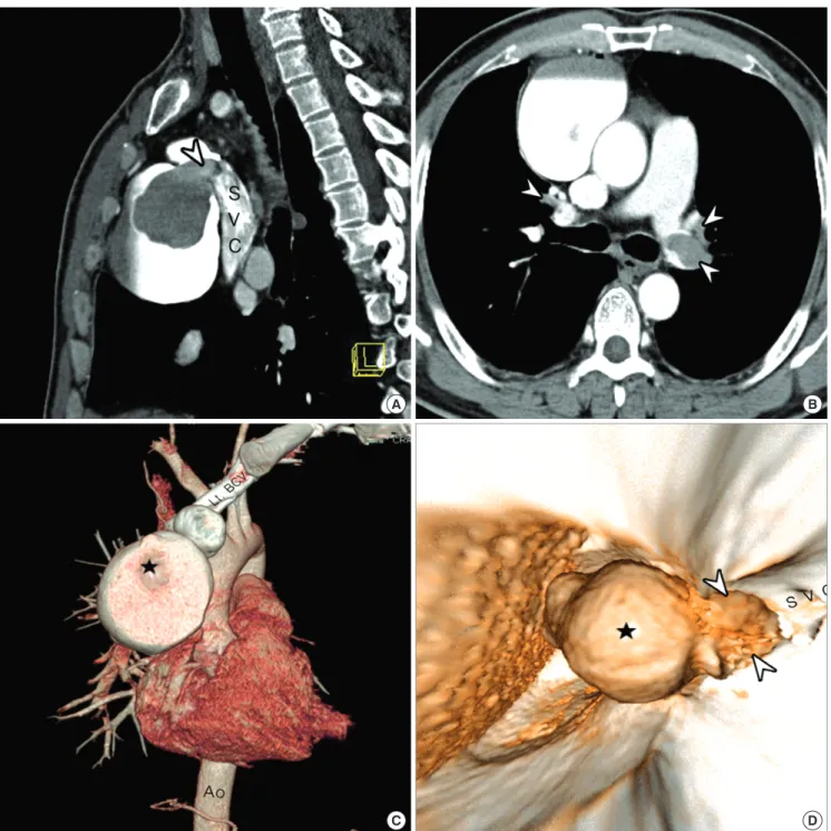 Fig. 2. Multiplanar reformat images (A, B) and three-dimensional volume rendered images (C, D) of chest computed tomographic angiography demonstrated the superior vena  cava (SVC) aneurysm with internal thrombi (★) protruding into the SVC through the narro