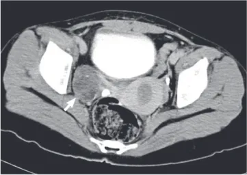 Fig. 1. Pelvic computed tomography. A 5.1 × 4 cm-sized, well-defined solid mass  with multiple calcifications and fat density is noted in right adnexa (arrow).