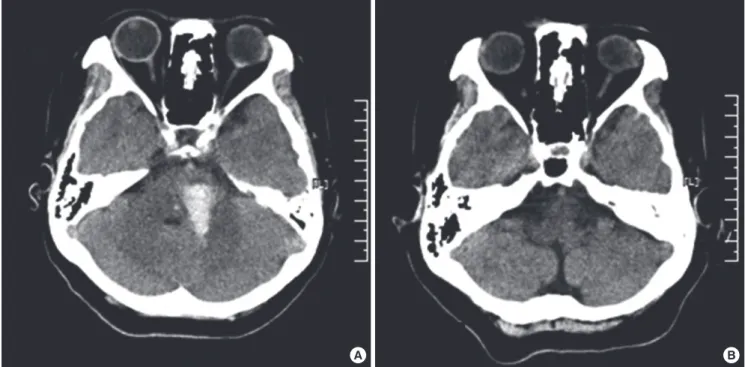 Fig. 1. Initial and follow-up computed tomography of the brain. (A) CT scans of the brain at the time of the first admission showed the left pontine area of hemorrhage measur- measur-ing 1.0 × 2.5 cm