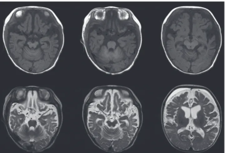 Fig. 2. EEG records of the case. (A) At first admission, the pattern is consistent with electrical partial seizures from the right temporal area