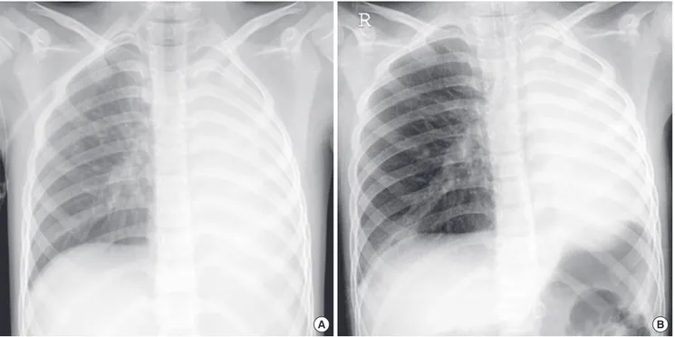 Fig. 1. Chest radiographs at the first attack with H1N1 infection in November, 2009 (A) and second attack with influenza B infection in April, 2010 (B) shows total atelectasis in  the left lung and hyperaeration in the right lung.
