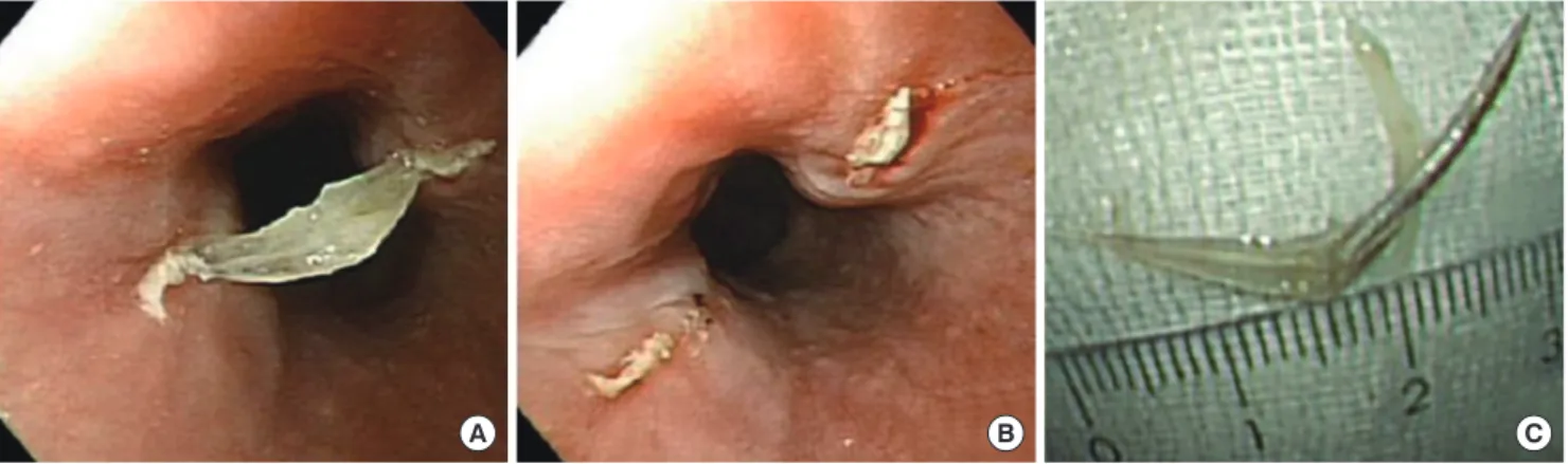 Fig. 2. Typical features of a fish bone foreign body due to Chromis notata’s anal fin spine-pterygiophore complex (ASPC)