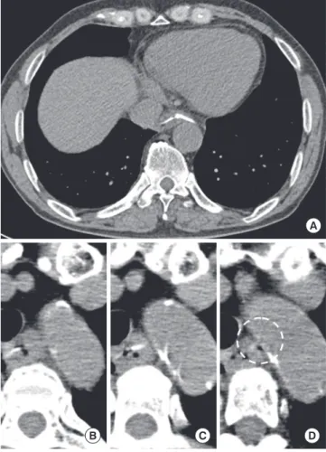 Fig. 4. Computed tomographic finding in two patients. (A) A typical case of esopha- geal damselfish bone foreign body