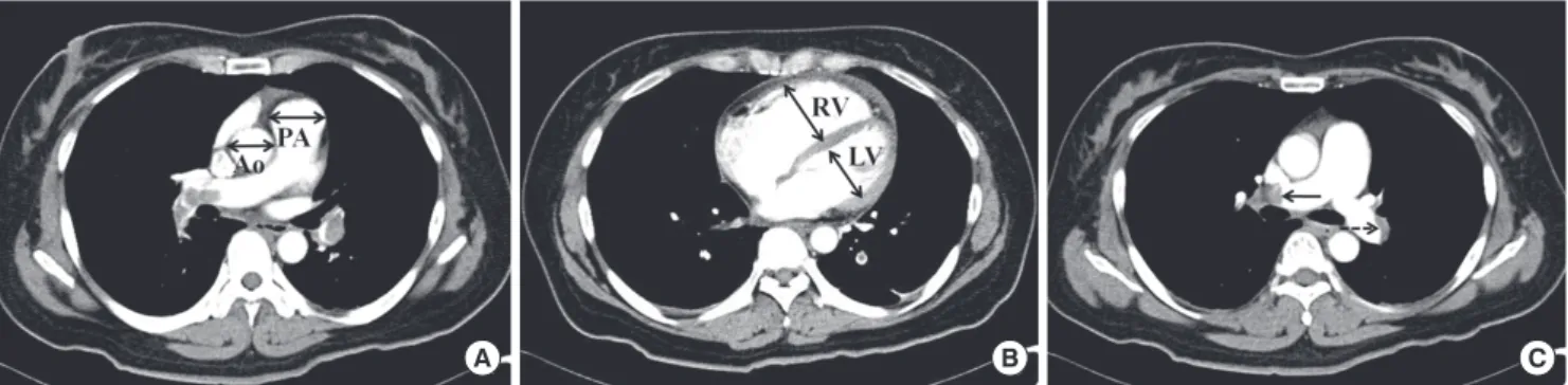 Fig. 1. Measurement of CT parameters. Measurement of diameters of the aorta and main pulmonary artery (A), and dimensions of the right and left ventricles (B)