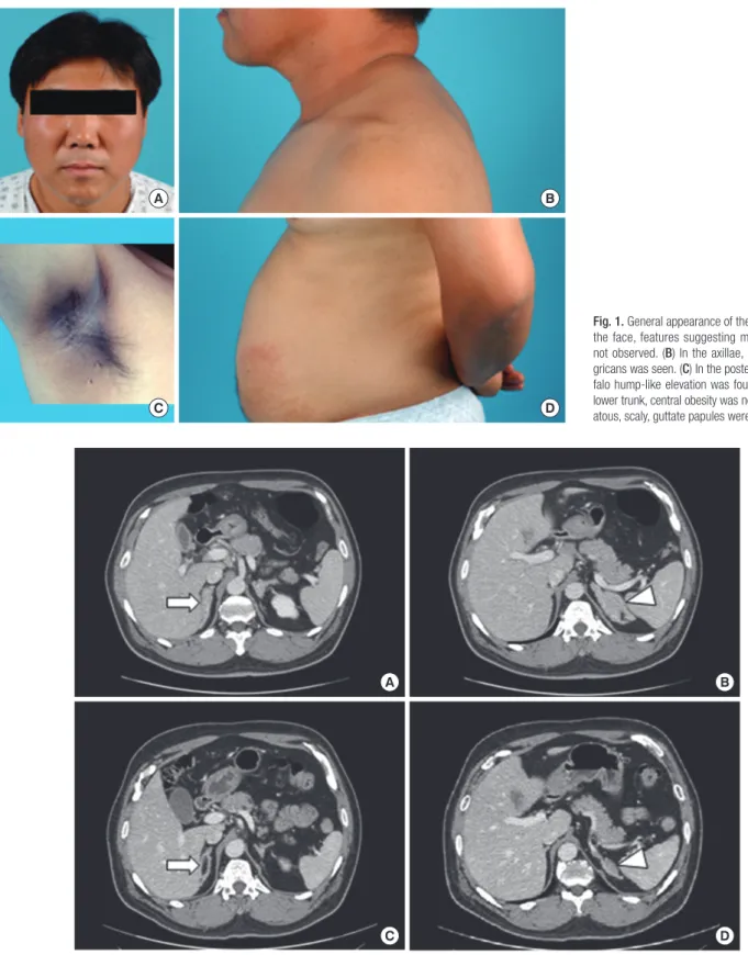 Fig. 1. General appearance of the patient. (A) In  the face, features suggesting moon face was  not observed