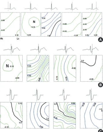 Fig. 4. Representative tracing of vector potential during QRS. (A) Normal control, (B) right bundle branch block, and (C) left bundle branch block patients