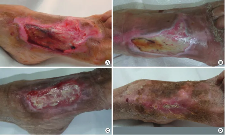 Fig. 1. Initial presentation and subsequent changes of cutaneous ulcer according to autologous PRP treatments