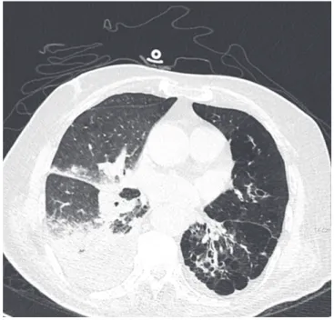 Fig. 4. Coronary artery angiography during the primary percutaneous coronary inter- inter-vention