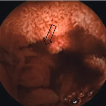 Fig. 2. Jejunal varices and main portal vein in multidetector CT; Axial scan and multiplanar reformation in multidetector CT show multiple and dilated jejunal varices (arrow)