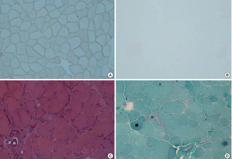 Fig. 1. Pathological features of dysferlinopathy. (A) Dysferlin in a normal muscle specimen by immunohistochemistry ( × 200)