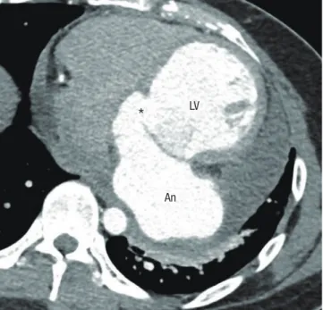 Fig. 2. Enhanced chest CT scan with axial image shows the pseudoaneurysm (An) of  the left ventricle (LV) at the level of the mitral valve, which is communicating via the  small opening (*)