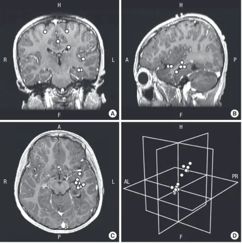 Fig. 2. MEG spike sources clustered around the le- le-sion and scattered in patient 12
