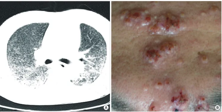 Fig. 1. Clinical features of disseminated P. marneffei infection. (A) Initial chest CT findings
